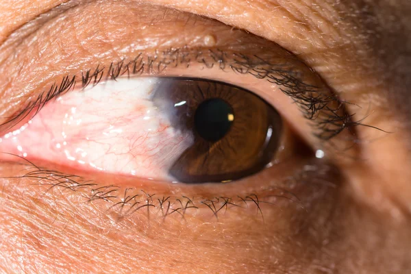 Exame ocular, pterígio avançado — Fotografia de Stock