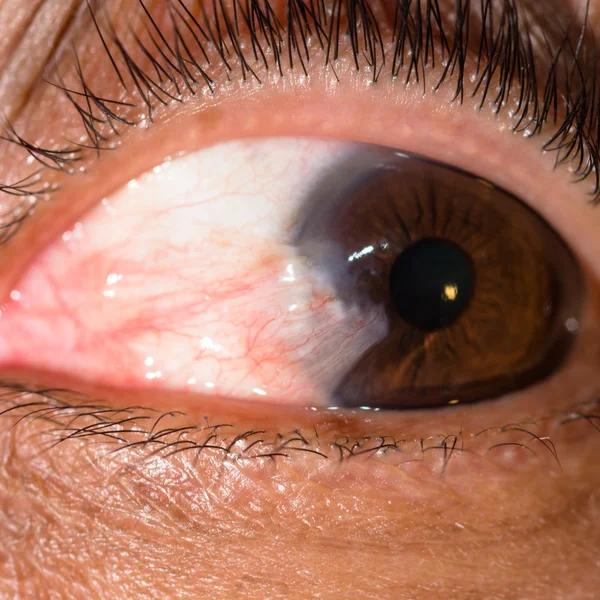 Augenuntersuchung, vorgeschobenes Pterygium — Stockfoto