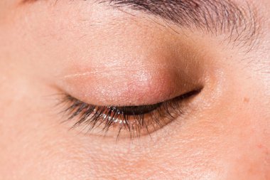 göz muayenesi, yazı Blefaroplasti