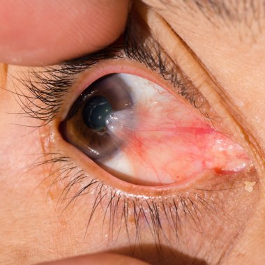 eye exam, pterygium clipart