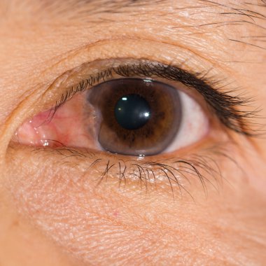 göz muayenesi, pterjium