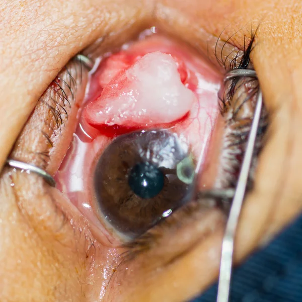 Eye exam, operation — Stock Photo, Image