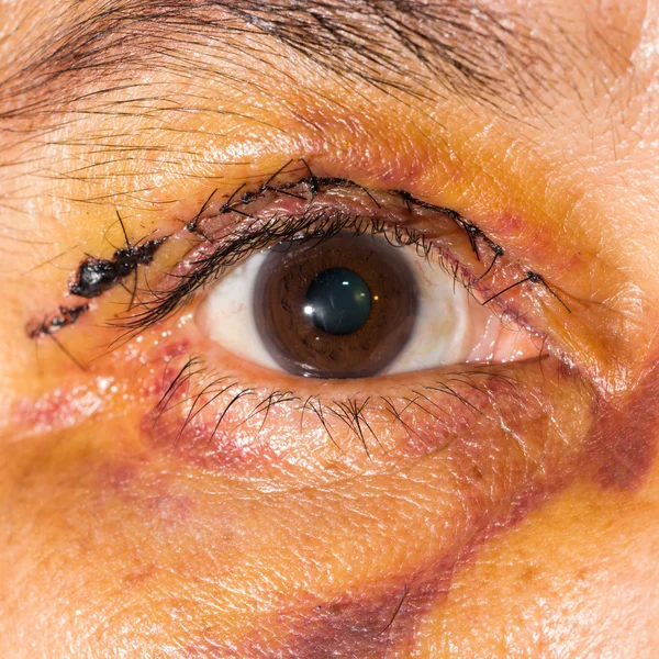 Pemeriksaan mata, setelah blepharoplasty — Stok Foto