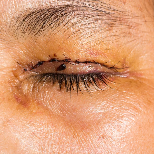 Eye exam, post blepharoplasty — Stock Photo, Image