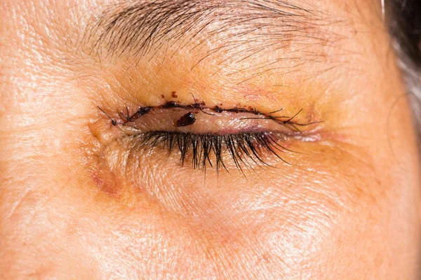 Eye exam, post blepharoplasty — Stock Photo, Image