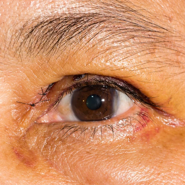 Eye exam, post blepharoplasty — Stock Photo, Image