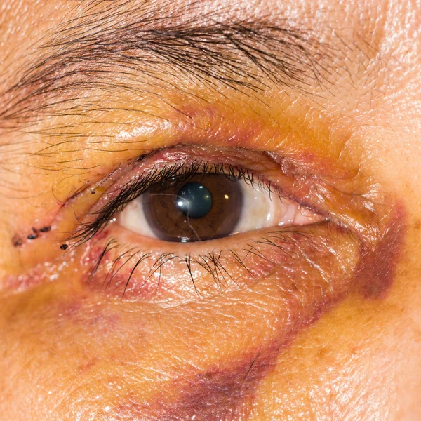 Exame oftalmológico, pós blefaroplastia — Fotografia de Stock