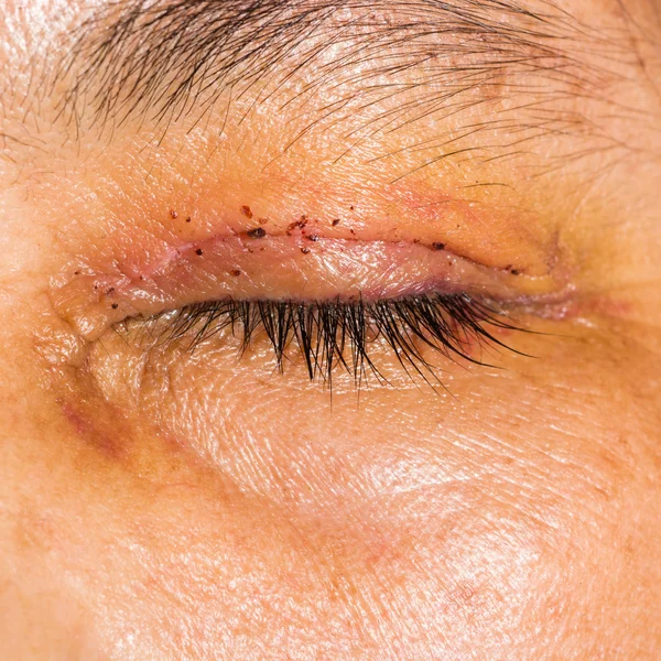 Ilmätutkimus, silmäluomien leikkauksen jälkeinen — kuvapankkivalokuva