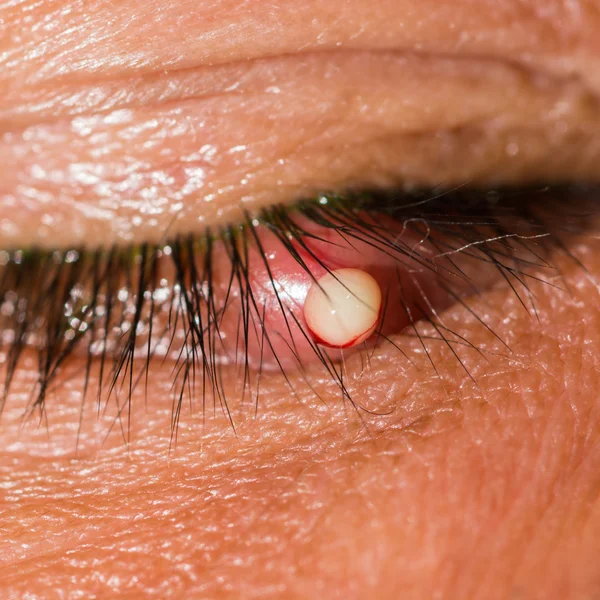 Eye exam, stye — Stock Photo, Image