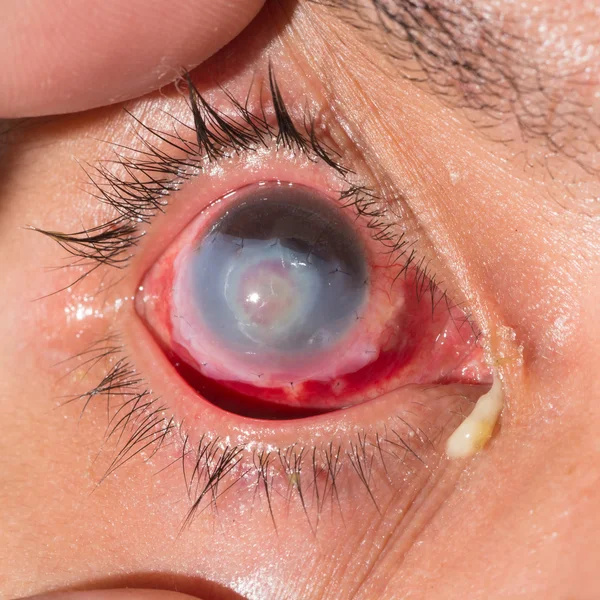 Eye exam, suture amnion membrane — Stock Photo, Image
