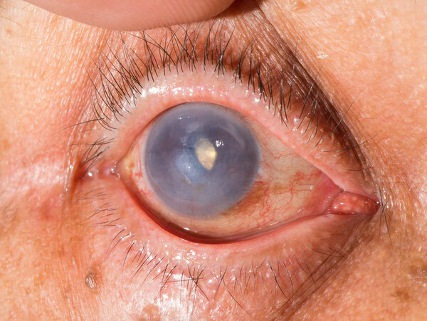 During eye examination
