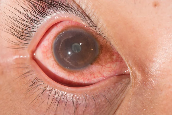 Eye exam, posterior synechia — Stock Photo, Image