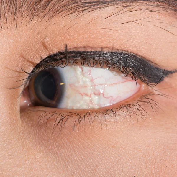 Examen ocular, quiste conjuntival — Foto de Stock