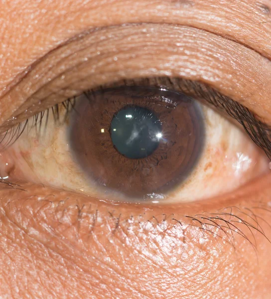 Oogonderzoek, sutural cataract — Stockfoto