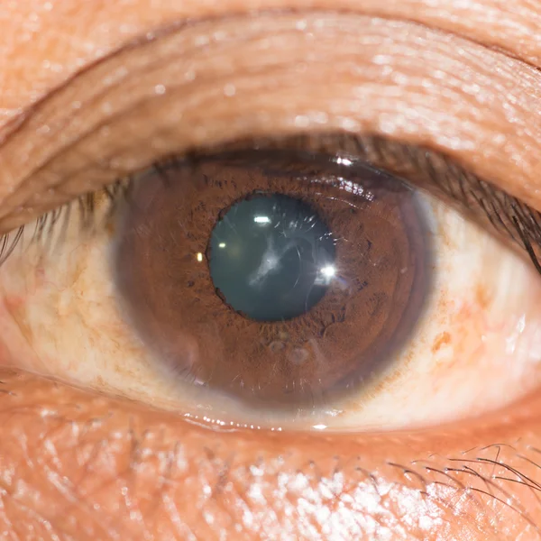 Oogonderzoek, sutural cataract — Stockfoto