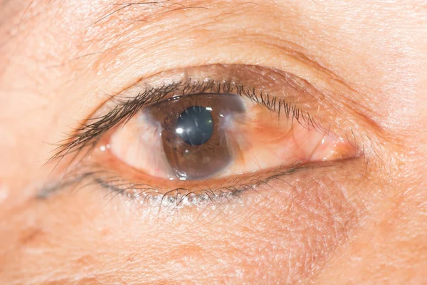 Synundersökning, advance pterygium — Stockfoto