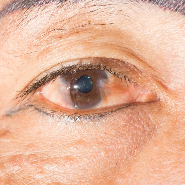 Exame ocular, pterígio avançado — Fotografia de Stock