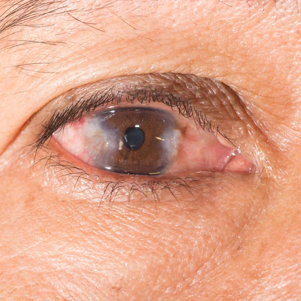 Eye exam, advance pterygium — Stock Photo, Image