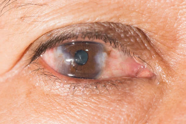 Esame dell'occhio, pterygium anticipo — Foto Stock