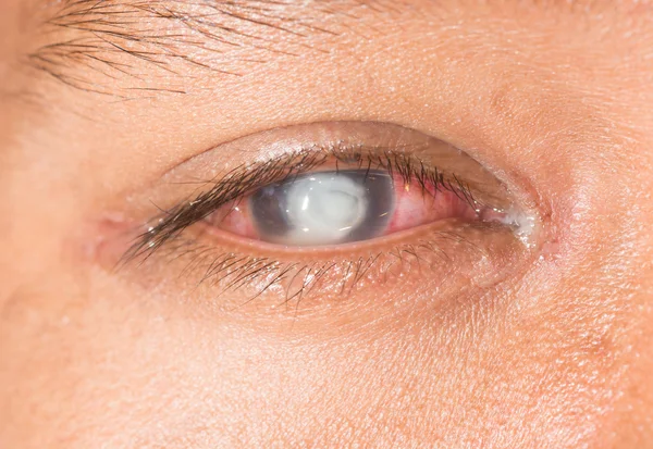 Exame oftalmológico, úlcera da córnea fúngica — Fotografia de Stock