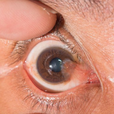 eye exam, advance pterygium clipart