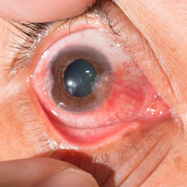 göz muayenesi, önceden pterjium
