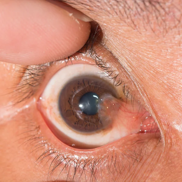 Eye exam, advance pterygium — Stock Photo, Image