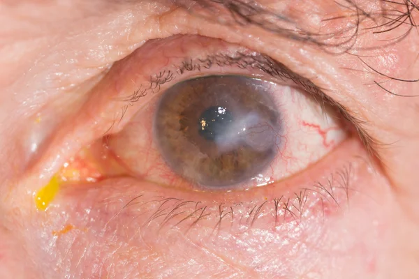 Eye exam, interstitial keratitis — Stock Photo, Image