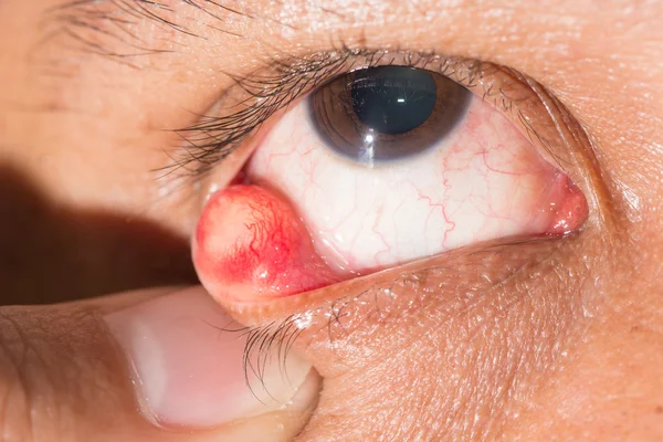 Augenuntersuchung, Chalazion — Stockfoto