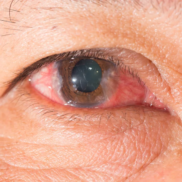 Synundersökning, advance pterygium — Stockfoto