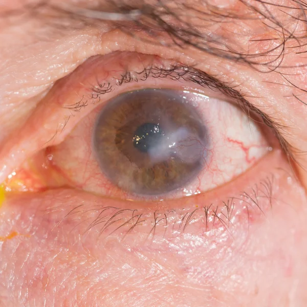 Oogonderzoek, interstitiële keratitis — Stockfoto