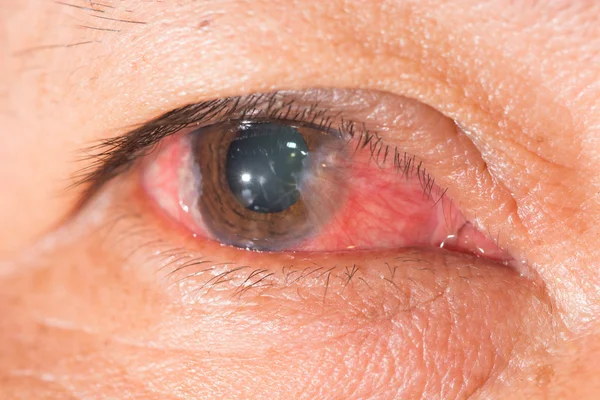 Synundersökning, advance pterygium — Stockfoto