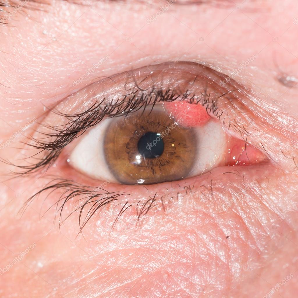 papillomavirus yeux)