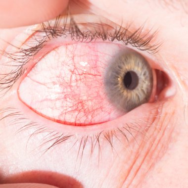 episcleritis göz muayenesi