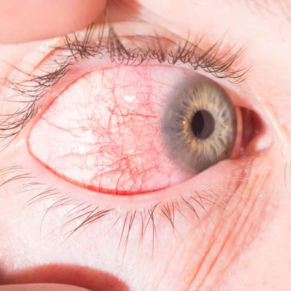 Episcleritis at eye examination — стоковое фото