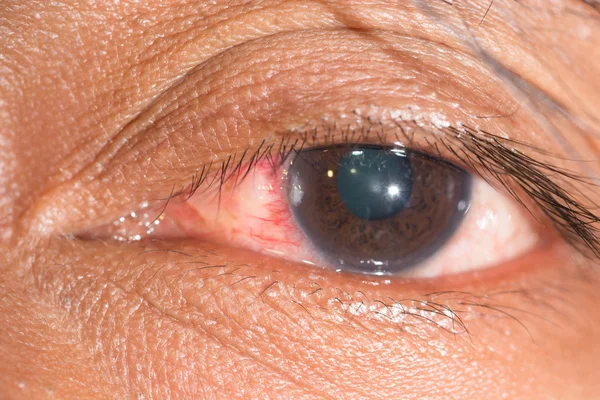 Cuerpo extraño de la córnea, examen ocular — Foto de Stock