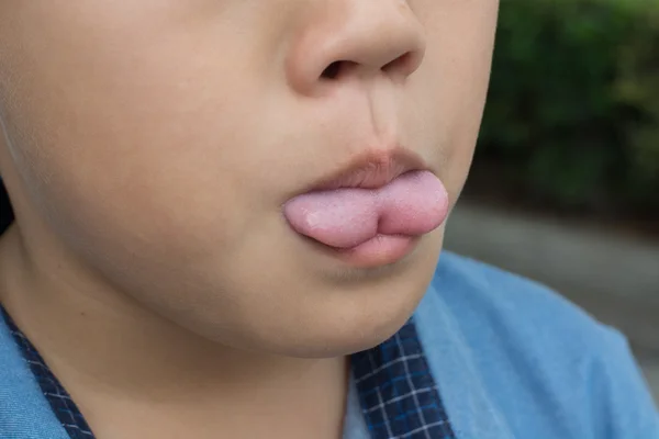 Tongue Tie, pre operation — Stock Photo, Image