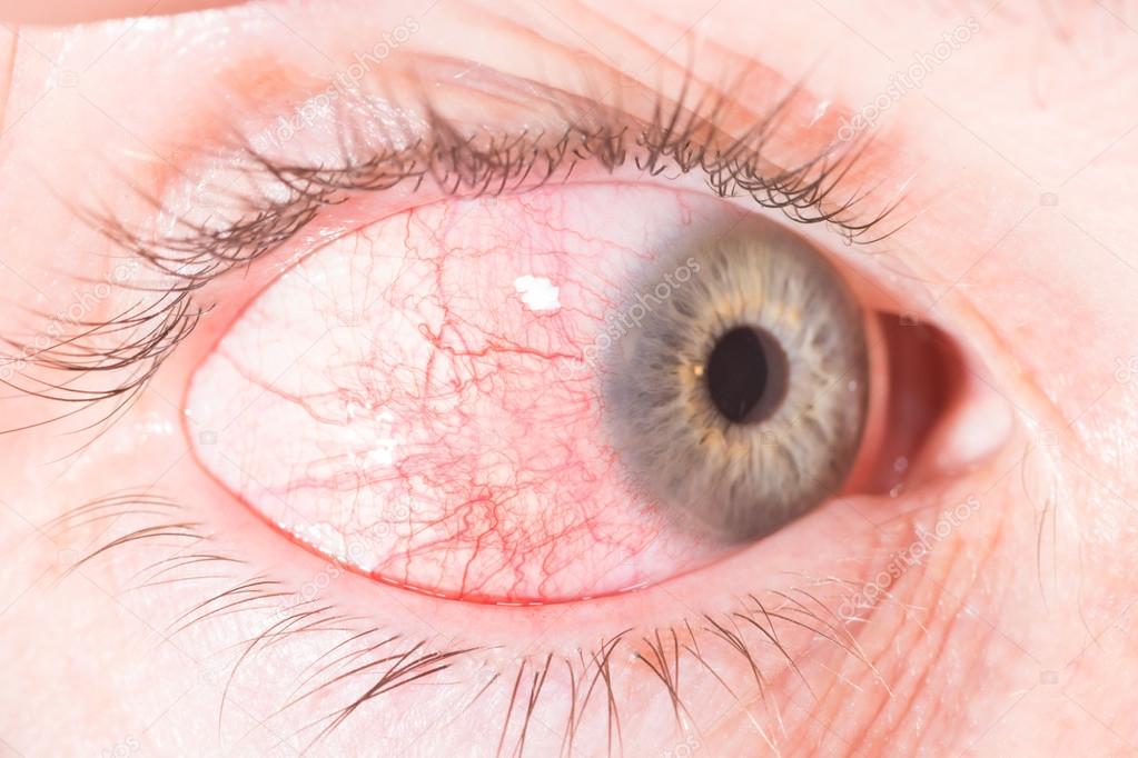 episcleritis at eye exam
