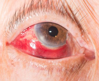 göz testi, Konjonktival kanama