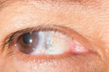 scleral melting at eye test clipart