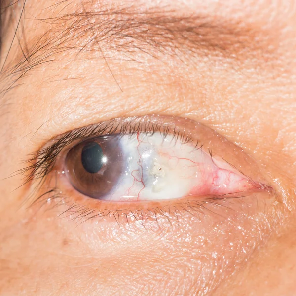 Scleral smelten op oogtest — Stockfoto