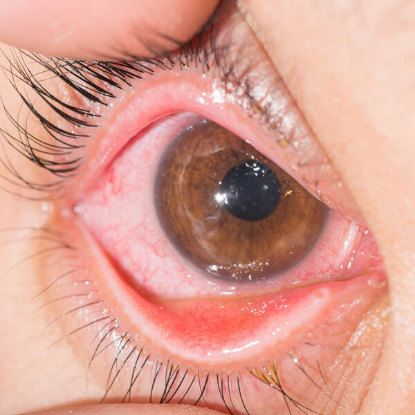 acute viral conjunctivitis at eye test