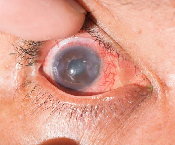 Acute anterior uveitis op oogtest — Stockfoto