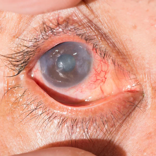 Acute anterior uveitis op oogtest — Stockfoto