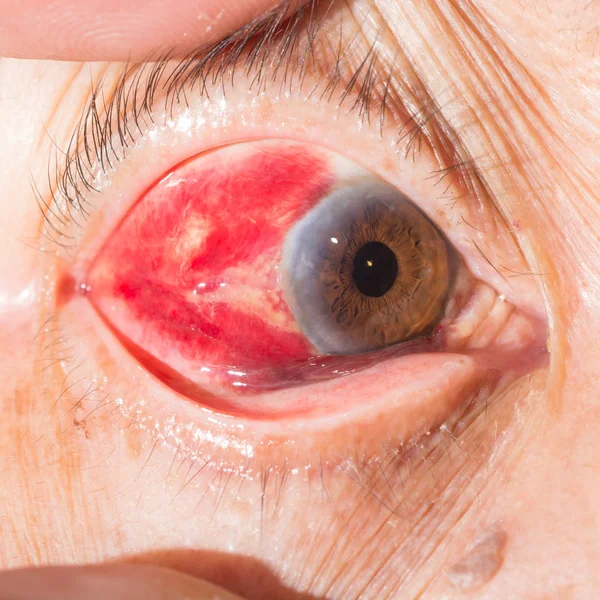 Conjunctival heamorrhage at eye test — Stock Photo, Image