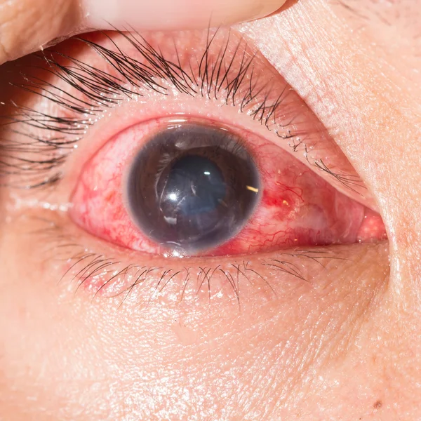 Conjunctivitis at eye test — Stock Photo, Image