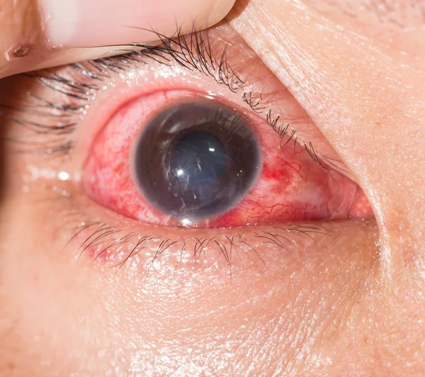 Conjunctivitis at eye test — Stock Photo, Image