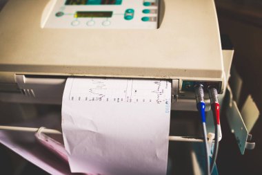 Cenin monitörü. Stressiz baskı, bebeğin kalp atışları. Anne hastanede bebek doğurtuyor. Kardiyogram raporu. Doğum odasında elektrokardiyografi. Hastanede taç yaprağı kalp atışı raporu.