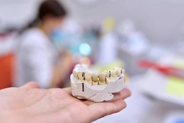 Sádrovcový model zubů čelisti s keramickými korunami — Stock fotografie