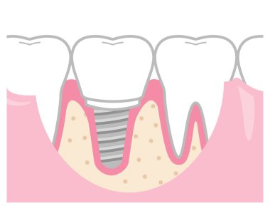 İşlenmiş diş implantı. İmplantla tedavi edilmiş bir diş örneği..